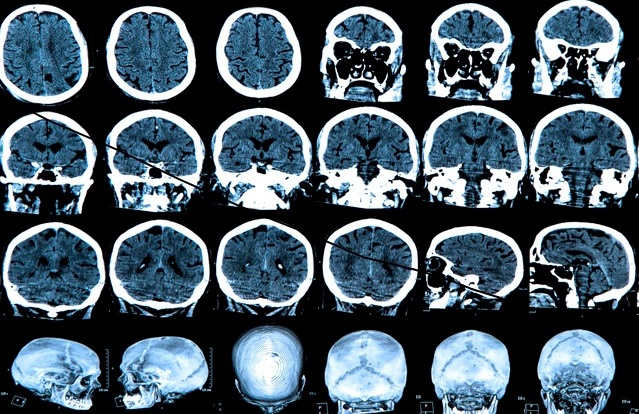 Neurodegenerative Disorder in Children in hanamkonda